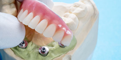 South Jersey Dental Implants