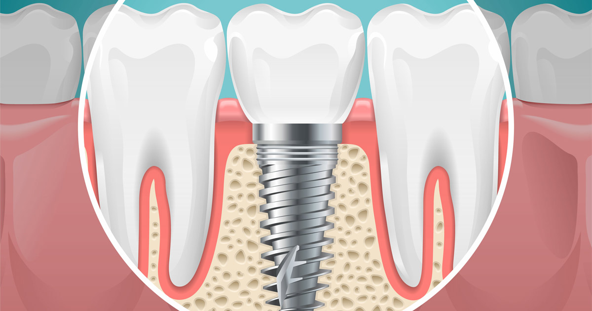 need Dental Implants