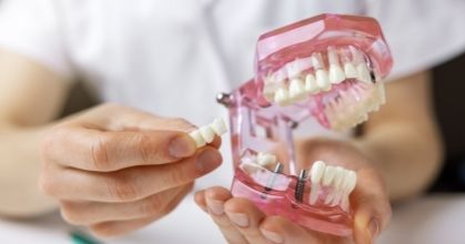 Dental Implants