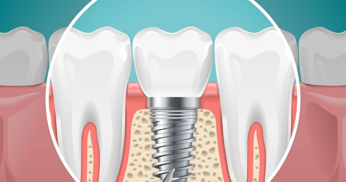 Dental Implant