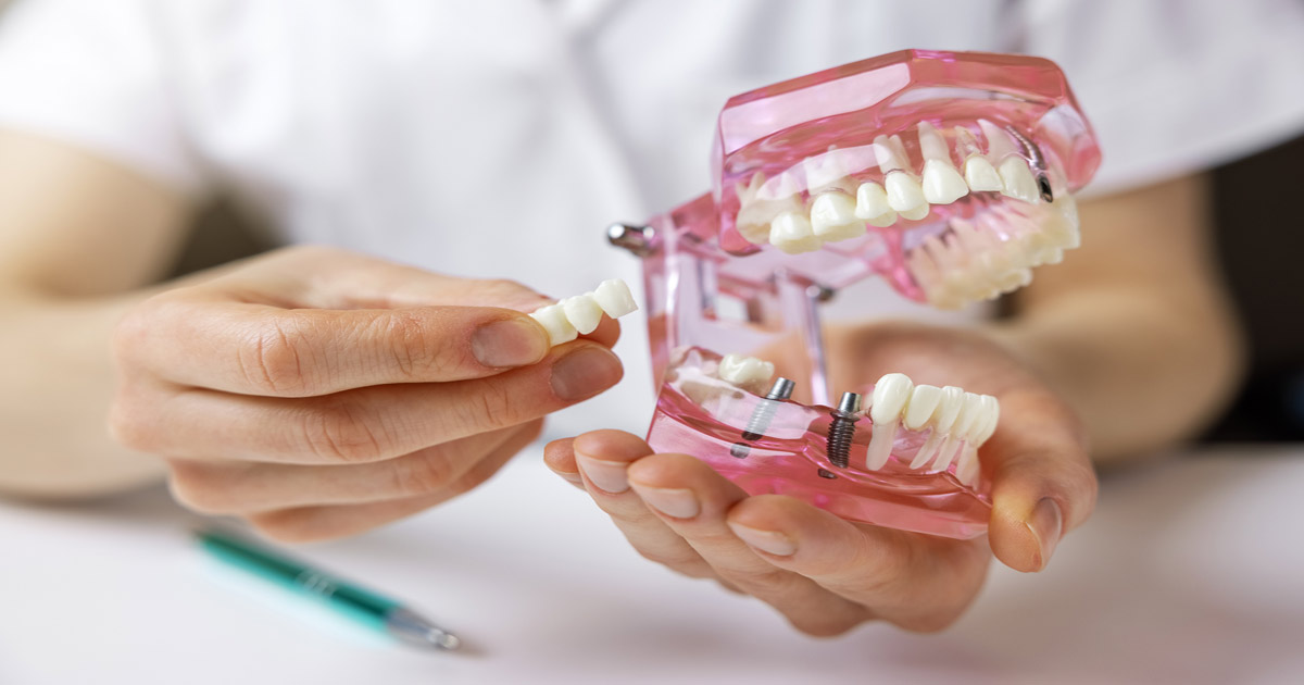 types dental implants