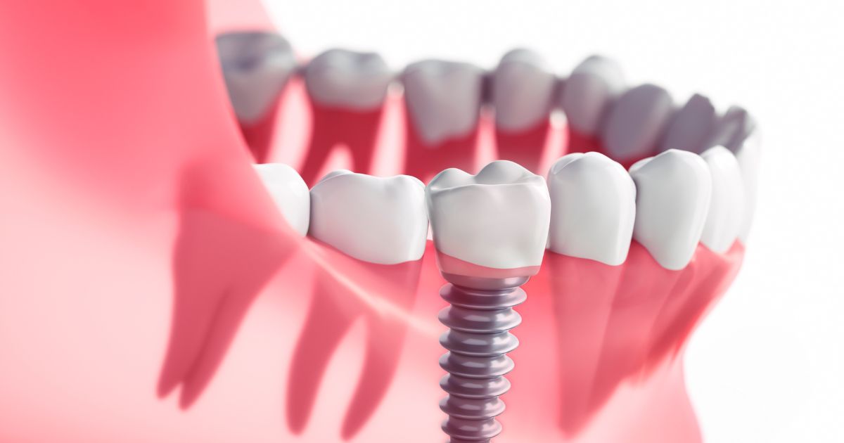 South Jersey Oral Surgeons at Lanzi Burke Oral & Maxillofacial Surgeons Provide Dental Implants for Patients With Missing or Broken Teeth.