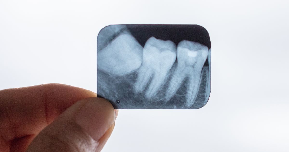 impacted wisdom teeth