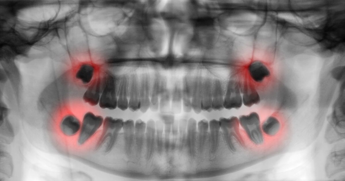 South Jersey Oral Surgeons at Lanzi Burke Oral & Maxillofacial Surgeons Perform Wisdom Teeth Extraction Surgery.