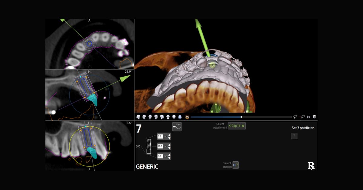 x-nav technology dental implant results