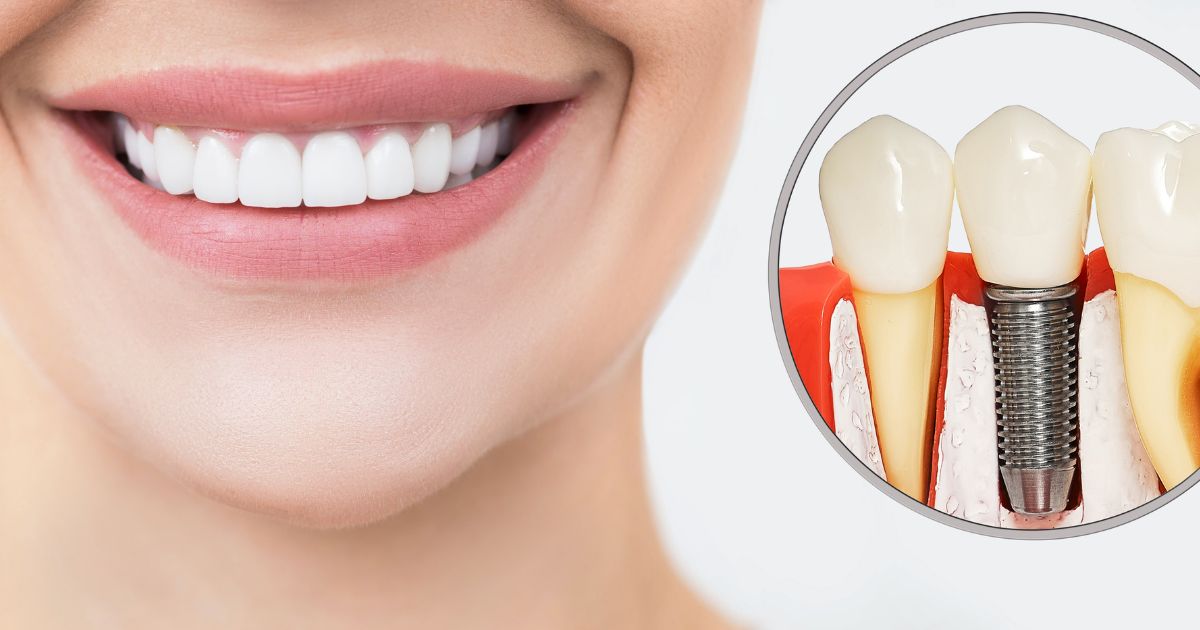 dental implants success