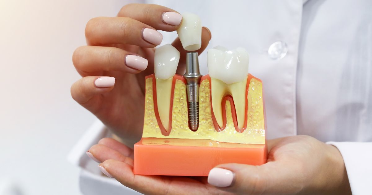 dental implant