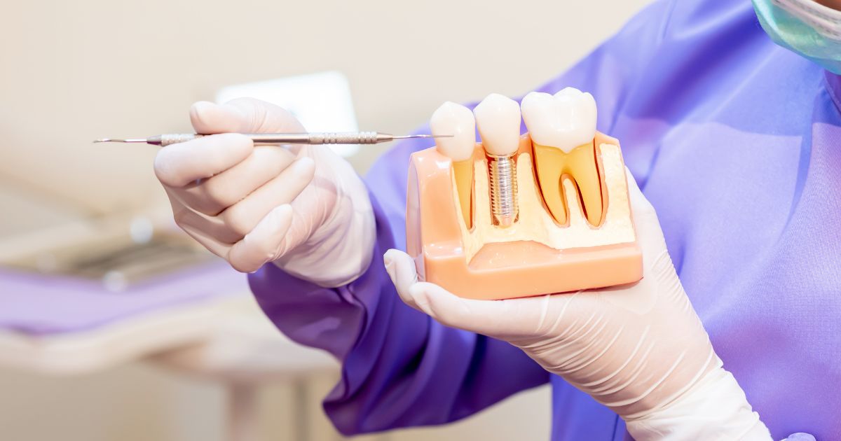 dental implants, can you get a cavity?