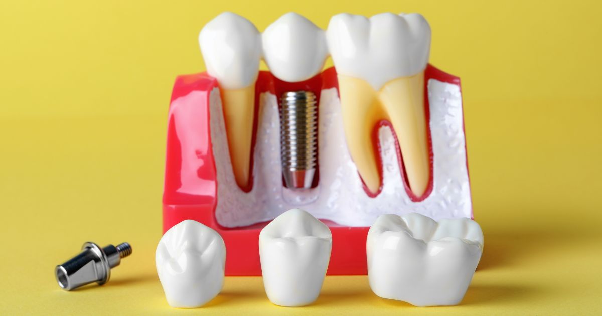 dental implants
