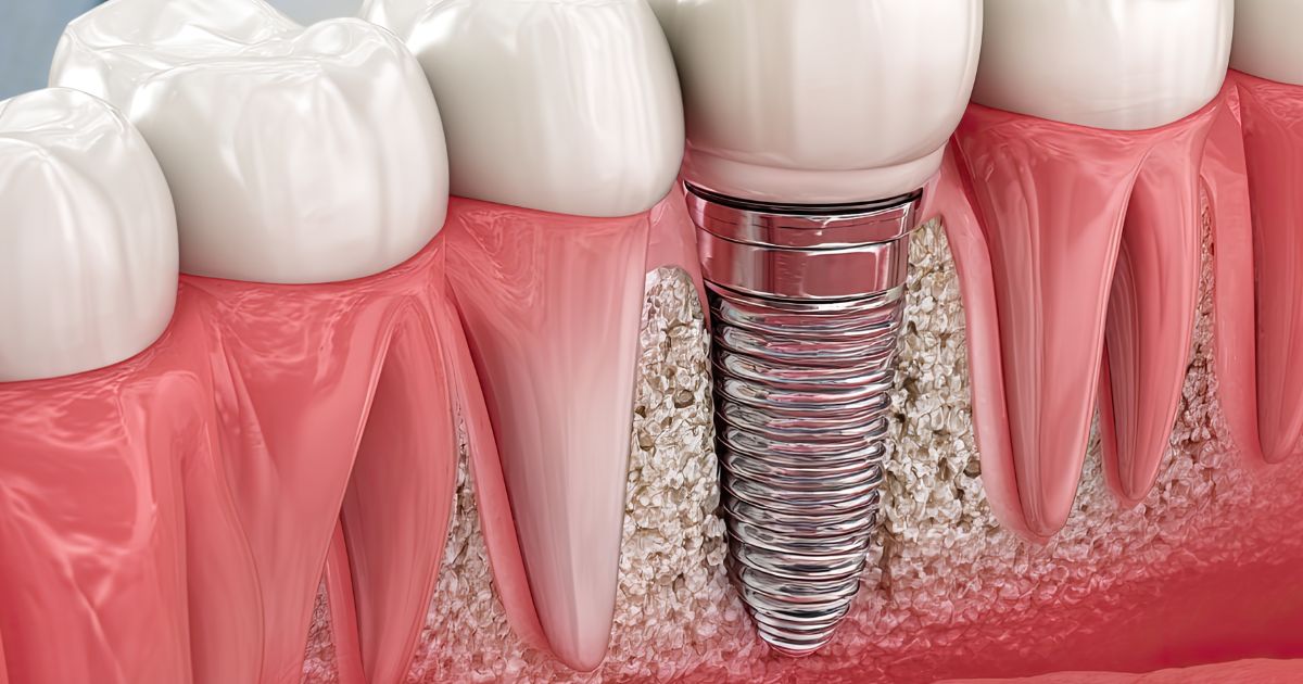 Subperiosteal Implants