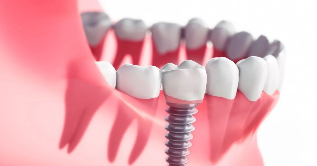 Schedule a Consultation With a South Jersey Oral Surgeon at Lanzi Burke Oral & Maxillofacial Surgeons