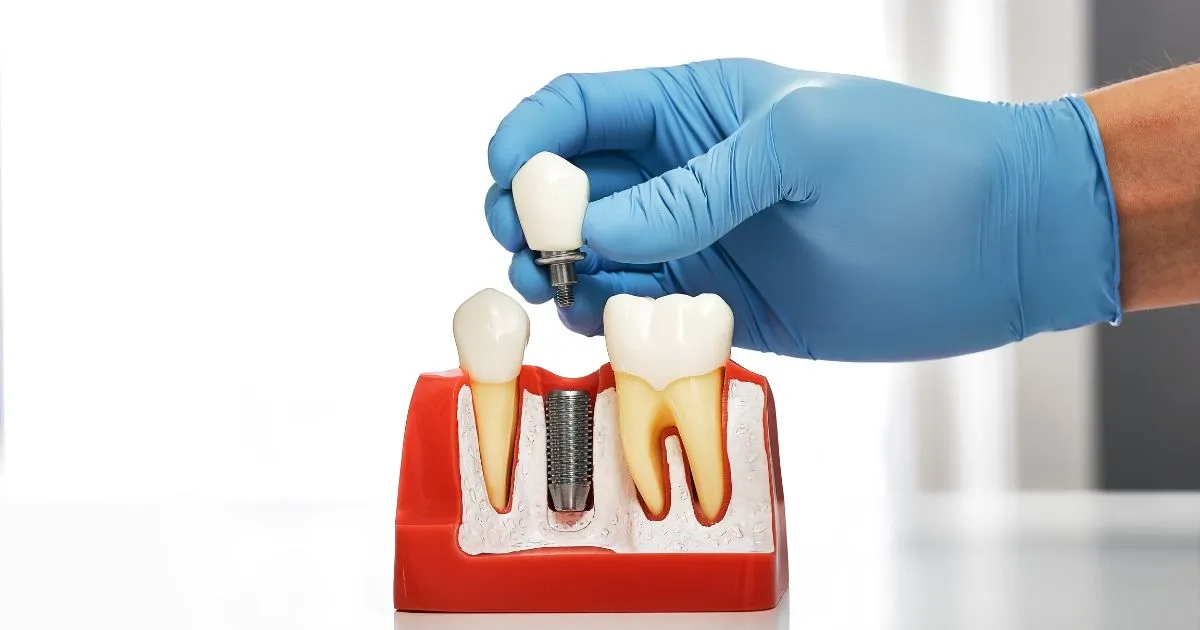 South Jersey Oral Surgeons at Lanzi Burke Oral & Maxillofacial Surgeons Will Answer Your Questions About Dental Implants