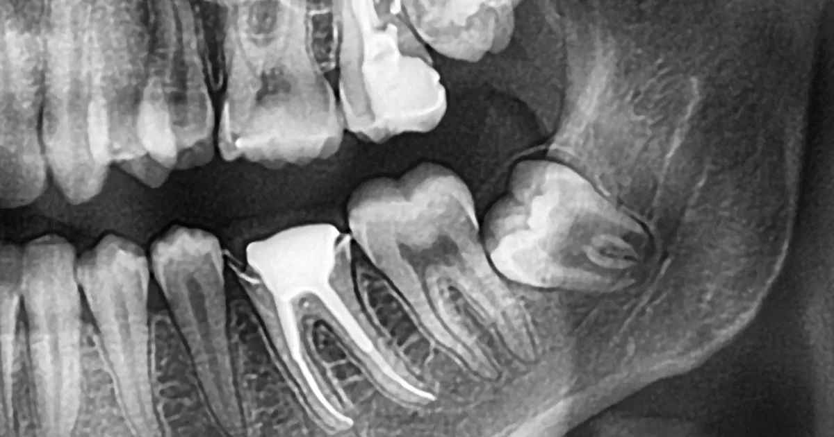 South Jersey Oral Surgeons at Lanzi Burke Oral & Maxillofacial Surgeons Help Protect the Foundation Beneath Your Smile