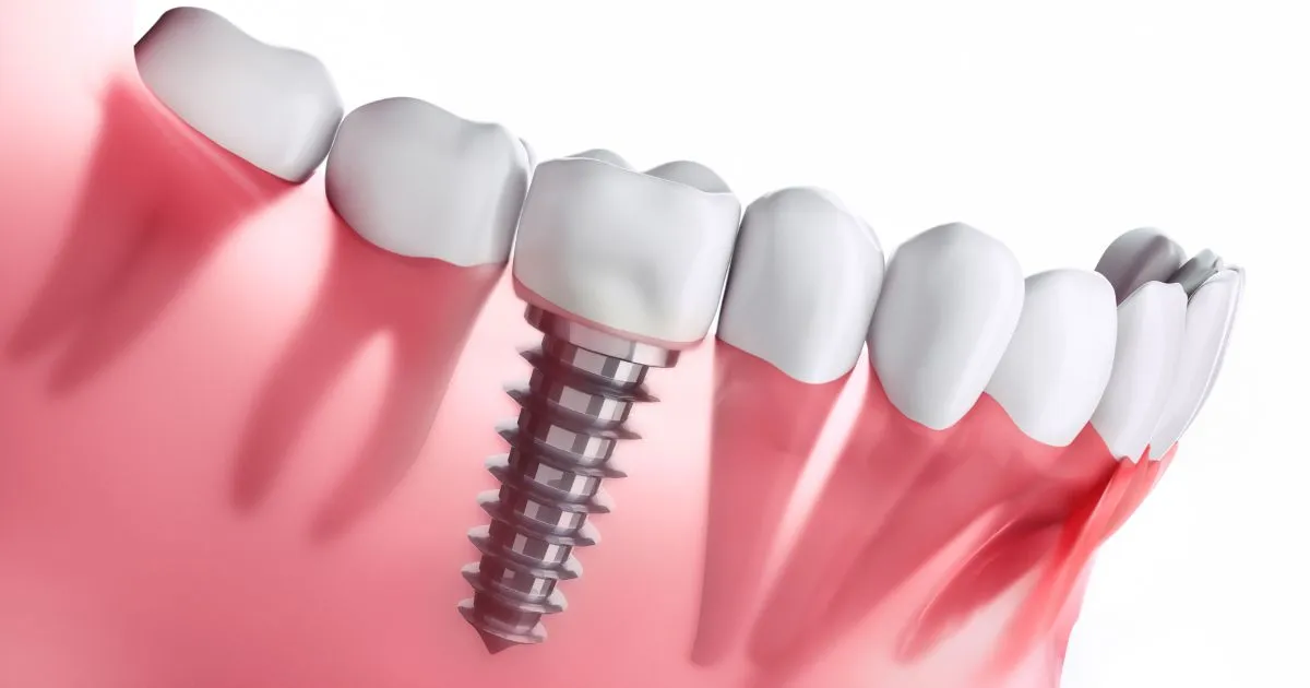 South Jersey Oral Surgeons at Lanzi Burke Oral & Maxillofacial Surgeons Help Patients Explore Advanced Implant Options