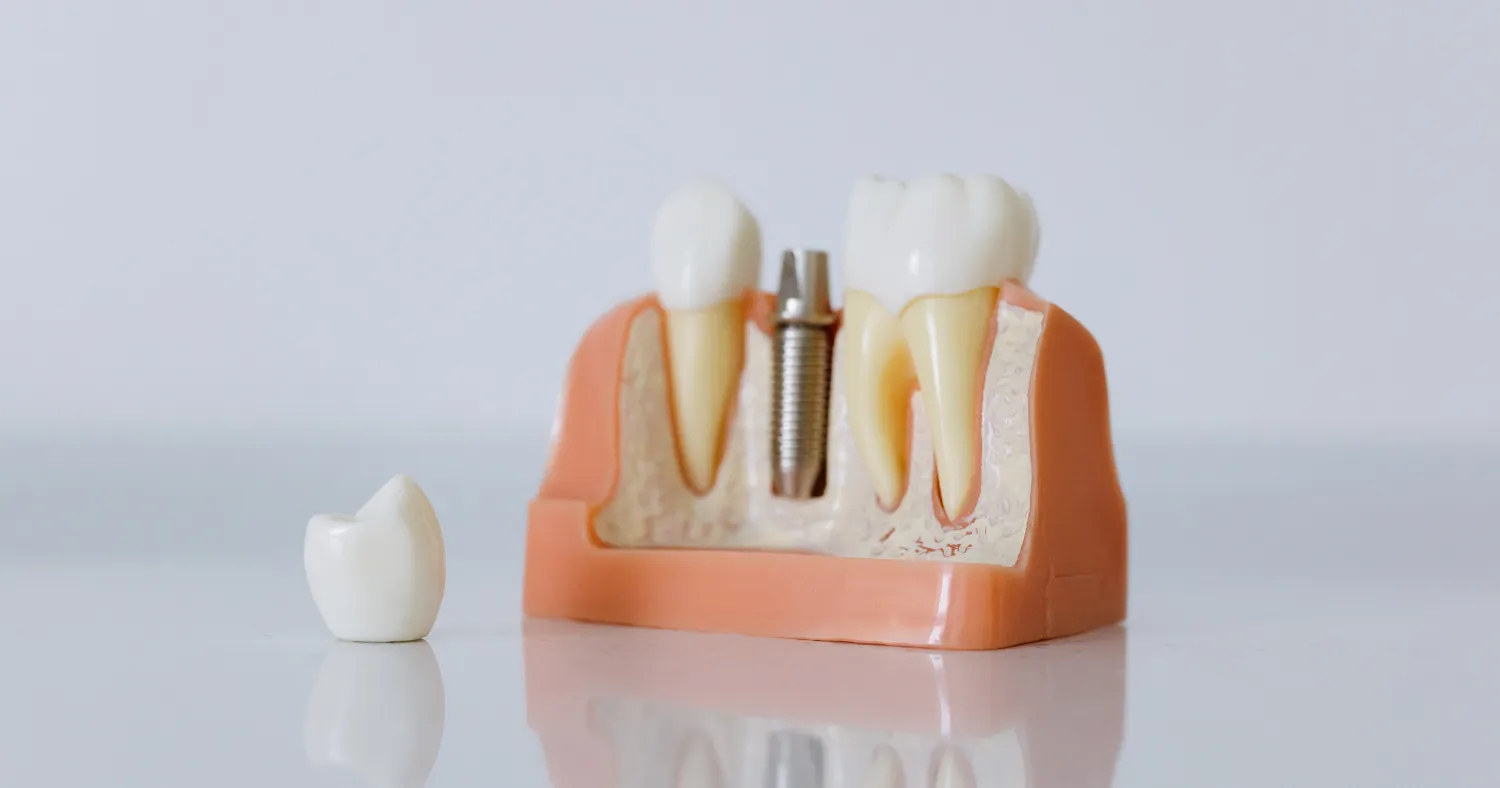 Implant tooth